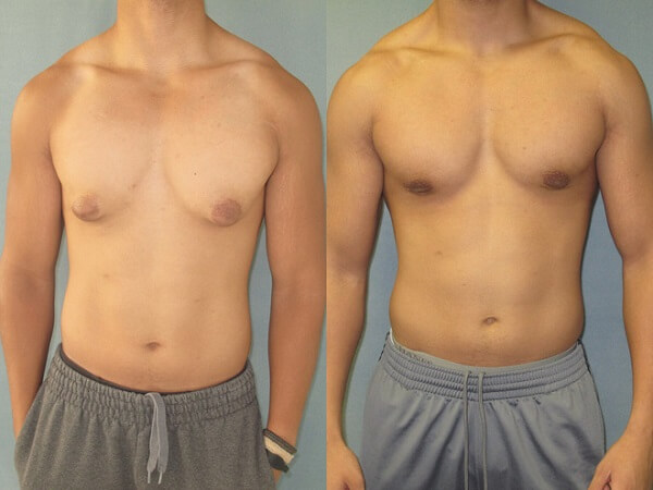 Cách giảm mỡ ngực nam, giảm mỡ ngực nam tránh ngực nhọn, tập giảm mỡ ngực nam