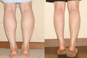 Cách nhận biết bắp chân to cơ địa – 1001 cách khắc phục nhược điểm bắp chân to